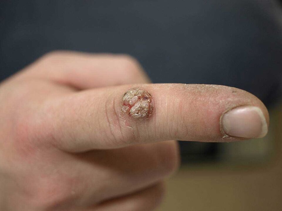 Large wart on a finger requiring removal