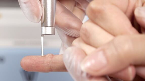 One of the methods to remove warts is the use of laser