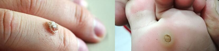 Wart on toes and plantar wart