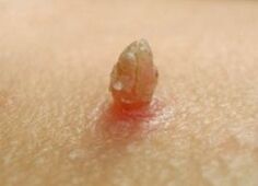 Acute papilloma