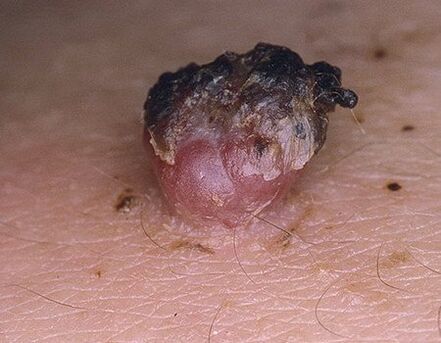 Belt papilloma