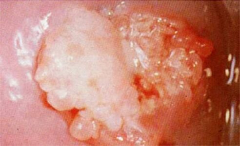 Candroid of the cervix