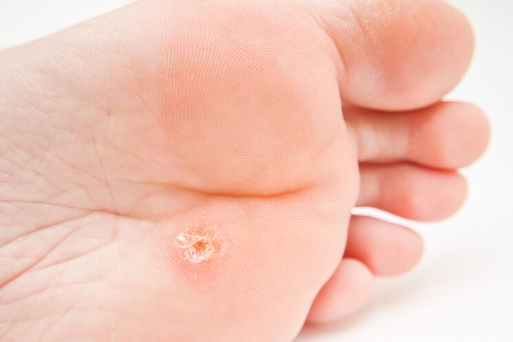 Sun warts