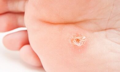 Because the plantar warts appear