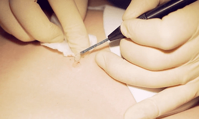 Surgical removal of the ward plantar