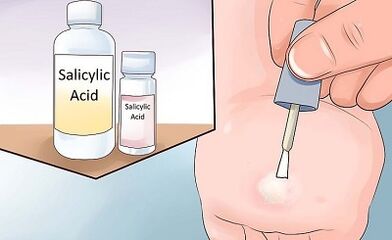 How to get rid of the folk streets of the Papillomes