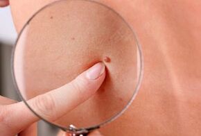 reasons for the appearance of papillomas on the human body