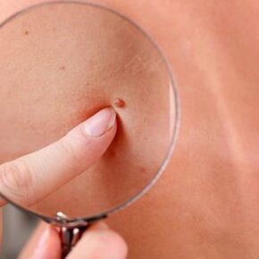 papillomas can be removed