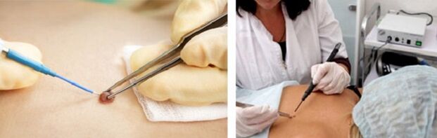 electrocoagulation as a method of removing papillomas