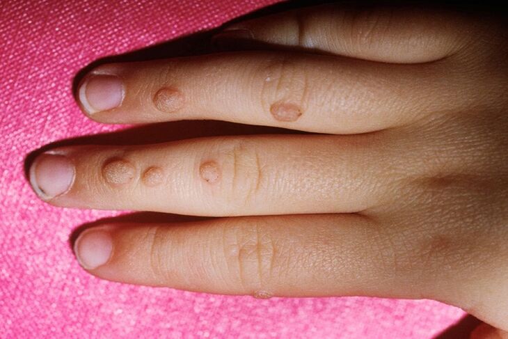 Vulgar warts on the fingers