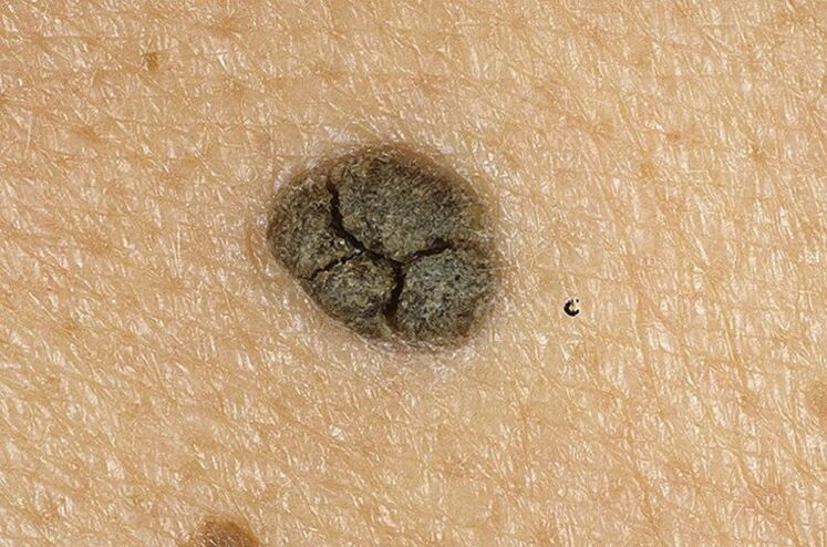 keratoma on body skin