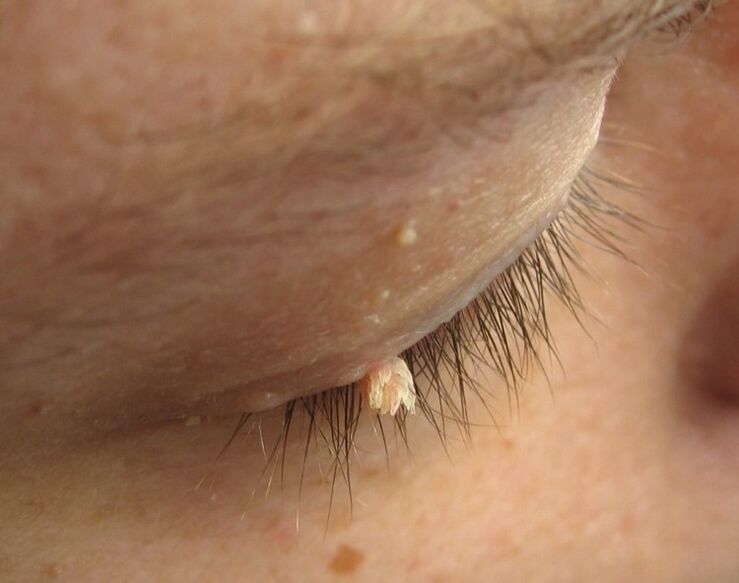 warts on the eyelid