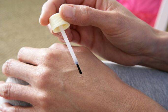 cauterization of warts with celandine juice
