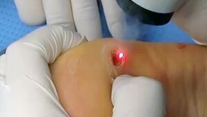 Removal of the plantar wart with the laser