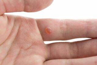 effective remedies for warts